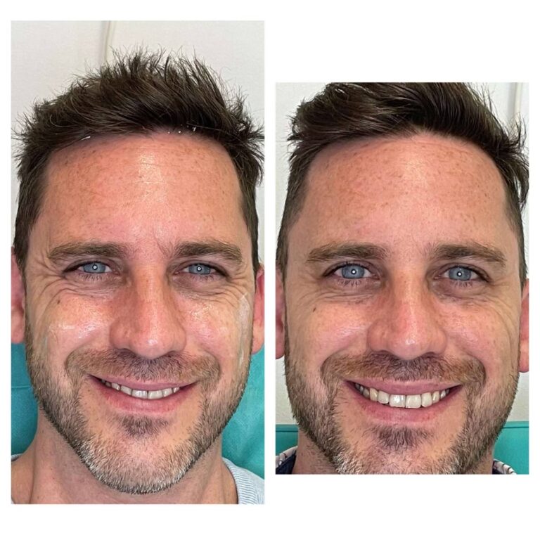 Rejuvenece tu Mirada: Guía de Lifting de Cejas