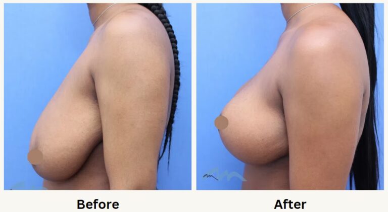 Levantamiento de Senos: ¿Cuánto Duran los Resultados?