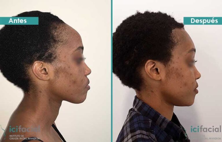 Corrección Ósea de la Frente: Guía Completa