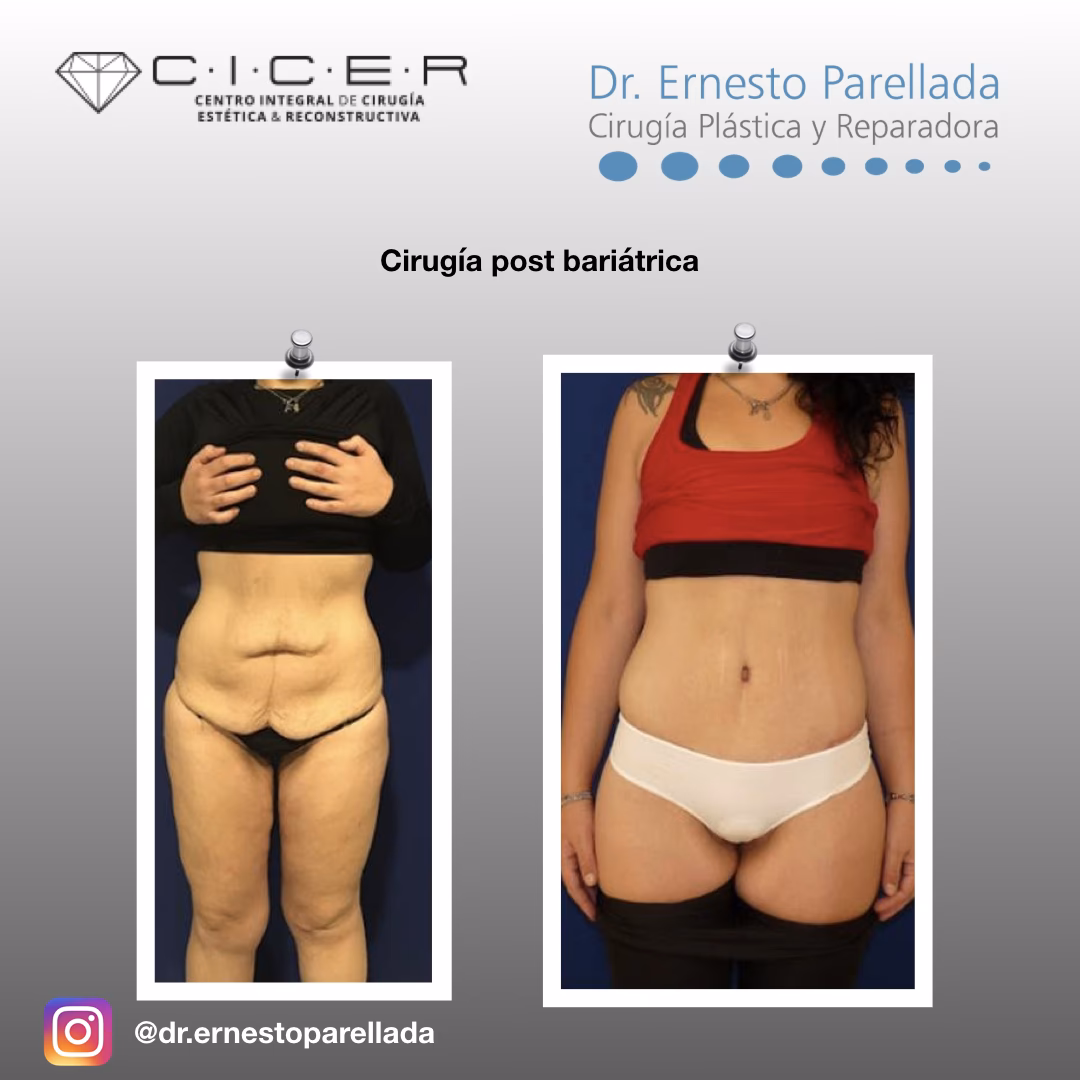 ¿Qué personas no son aptas para una abdominoplastia?