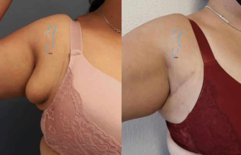 Mama Supernumeraria: Solución al Tercer Seno Axilar