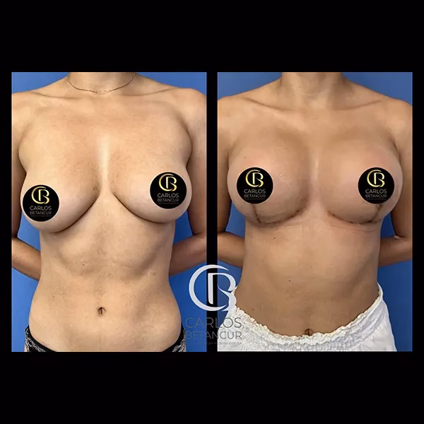 ¿Cuánto cuesta una cirugía para quitar los senos?