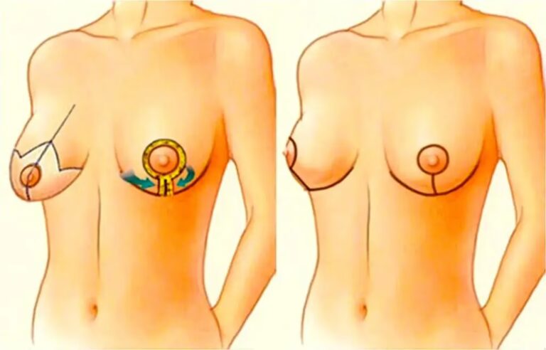 Recuperación de una Mamoplastia: Guía Completa
