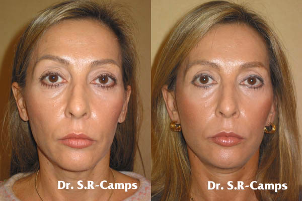 ¿Cuánto cuesta un lifting de mejillas?