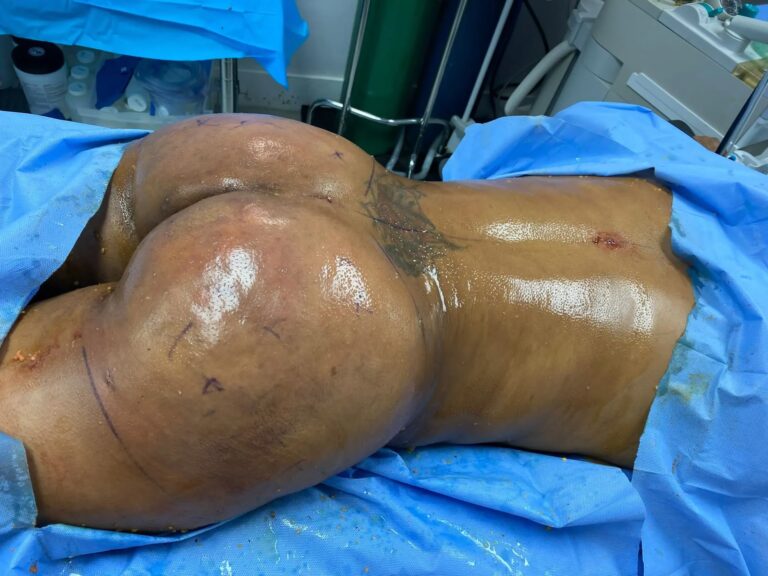 Guía del Levantamiento de Glúteos y su Recuperación