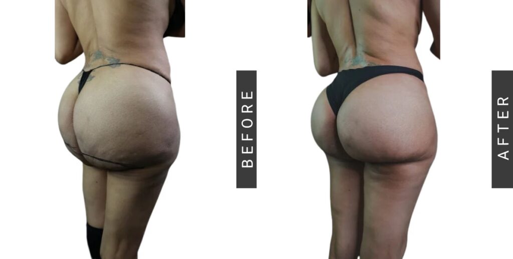 Aumento de Glúteos con Grasa: Guía Completa