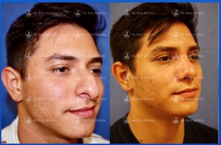 Corrige tu Nariz Caída sin Cirugía