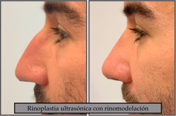 ¿Merece la pena la rinoplastia para los hombres?