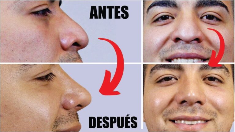 Rinoplastia Masculina: ¿Vale la Pena el Cambio?