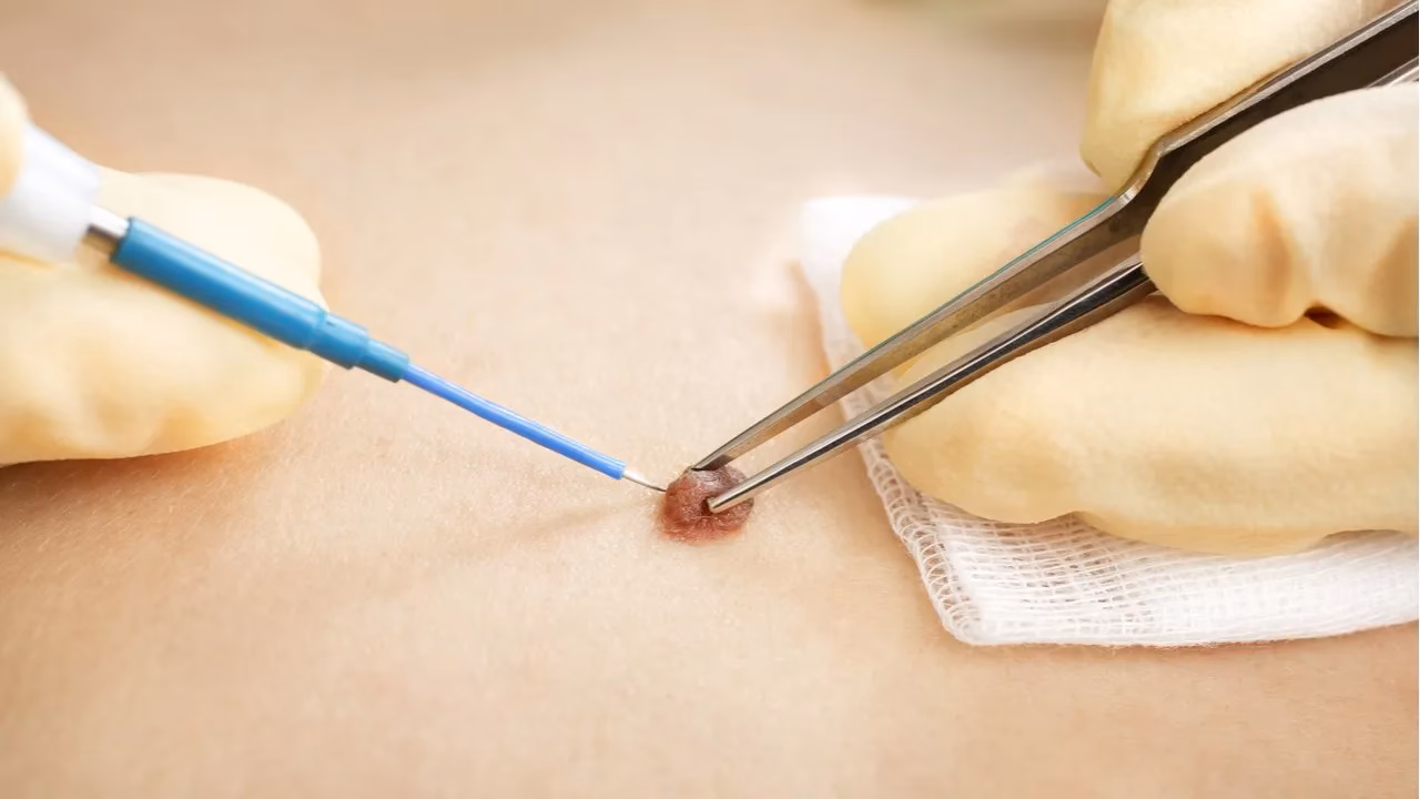 ¿Cuánto tarda en cicatrizar un nevus?