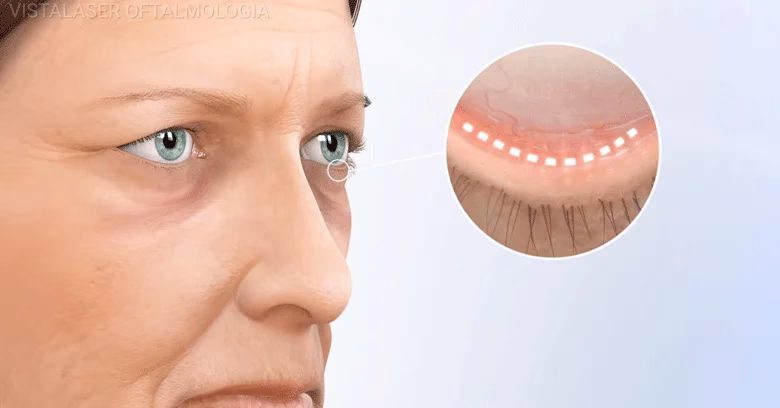 ¿Qué es una cirugía plástica ocular?