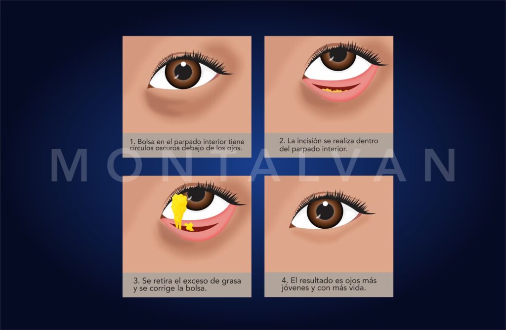 Cirugía para Agrandar los Ojos: Guía Completa