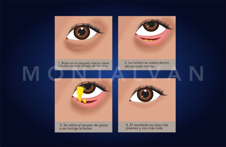 Adiós a los Ojos Saltones: Guía de Cirugía