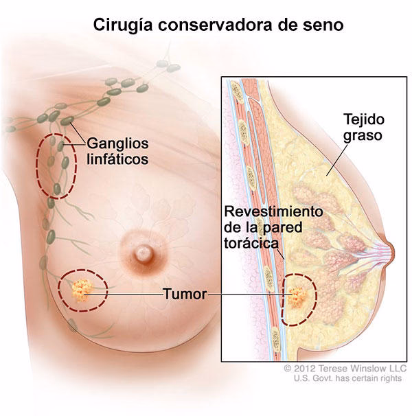 ¿Cómo se llama la cirugía que hacen en los senos para cuando tienen cáncer?