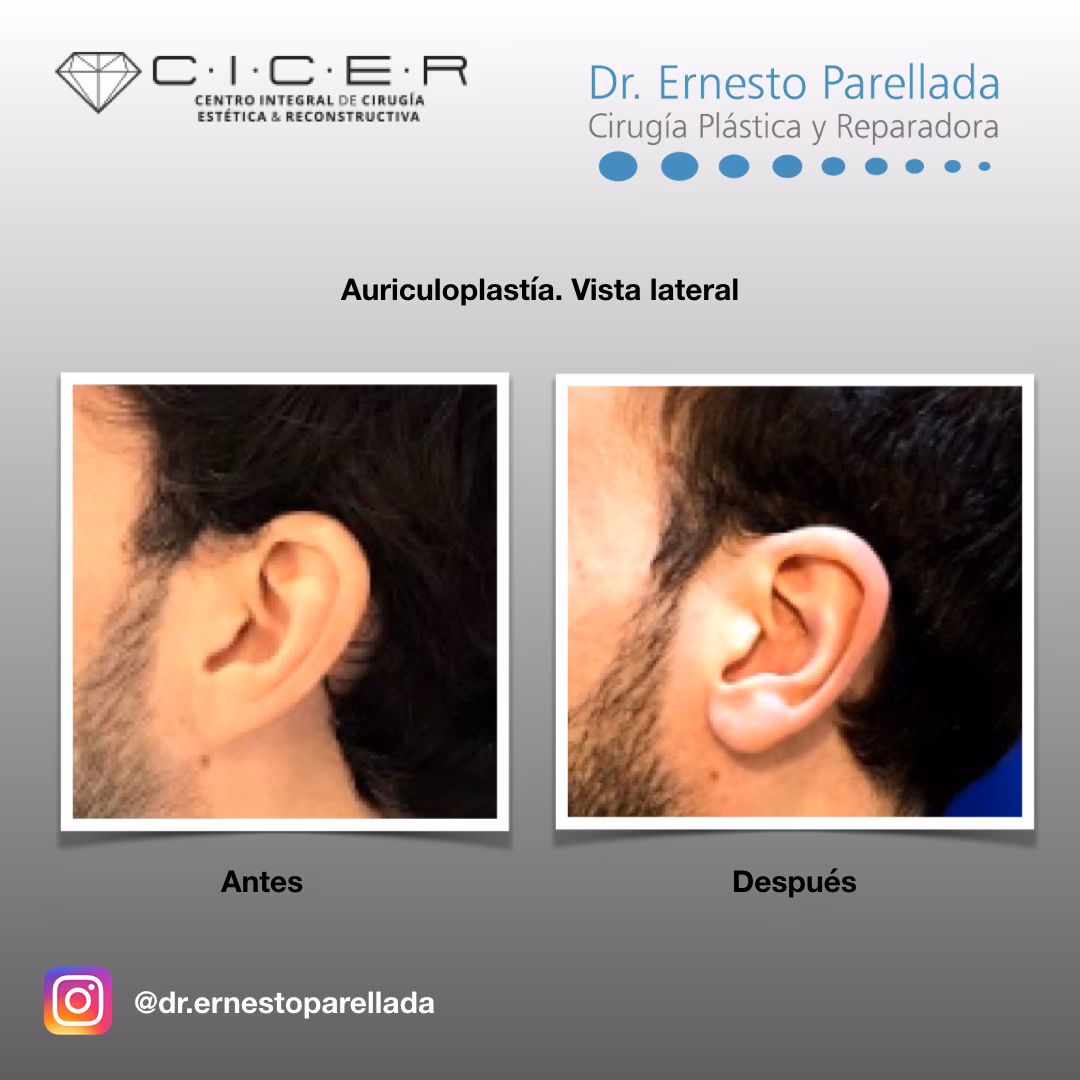 ¿Cuánto cuesta operarse las orejas en Argentina?