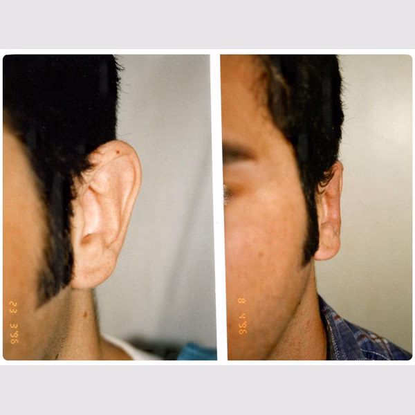 ¿Cómo se llama la cirugía para corregir las orejas en asa?