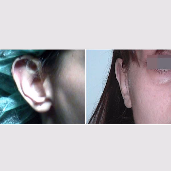 ¿Cómo se llama la cirugía para corregir las orejas en asa?