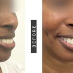 Dimpleplastia: La Cirugía para Crear Hoyuelos