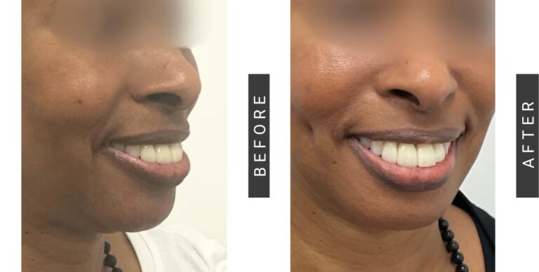 Dimpleplastia: La Cirugía para Crear Hoyuelos