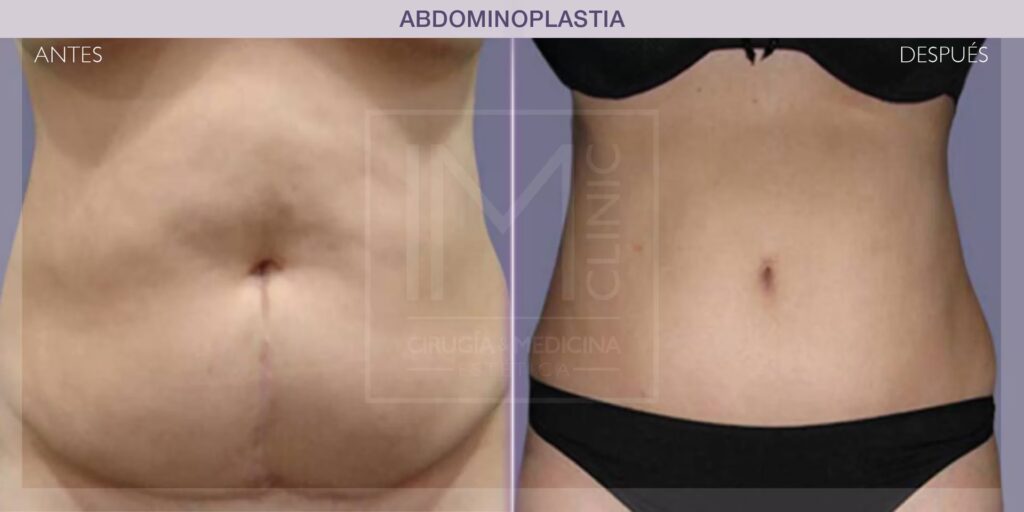 Abdominoplastia: Guía para un Vientre Plano