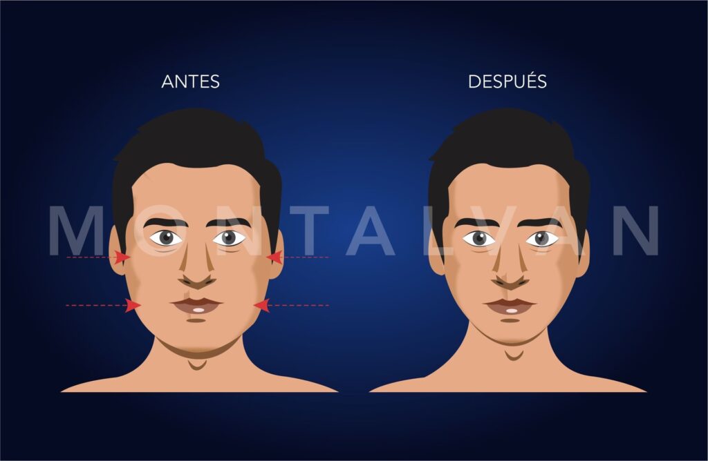 Adelgaza tu Rostro: Guía de Cirugía Facial