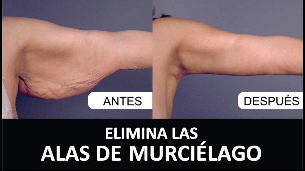 Braquioplastia: La Cirugía para Brazos Firmes