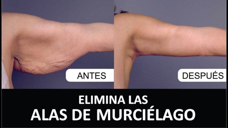 Braquioplastia: La Cirugía para Brazos Firmes