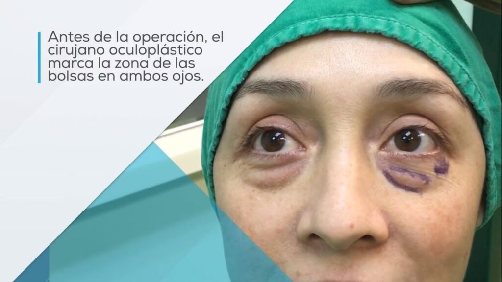 Precio de la Blefaroplastia: Lo que Debes Saber
