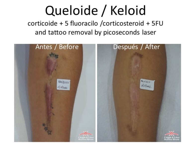 Extirpación de Queloides: Costos y Guía Completa