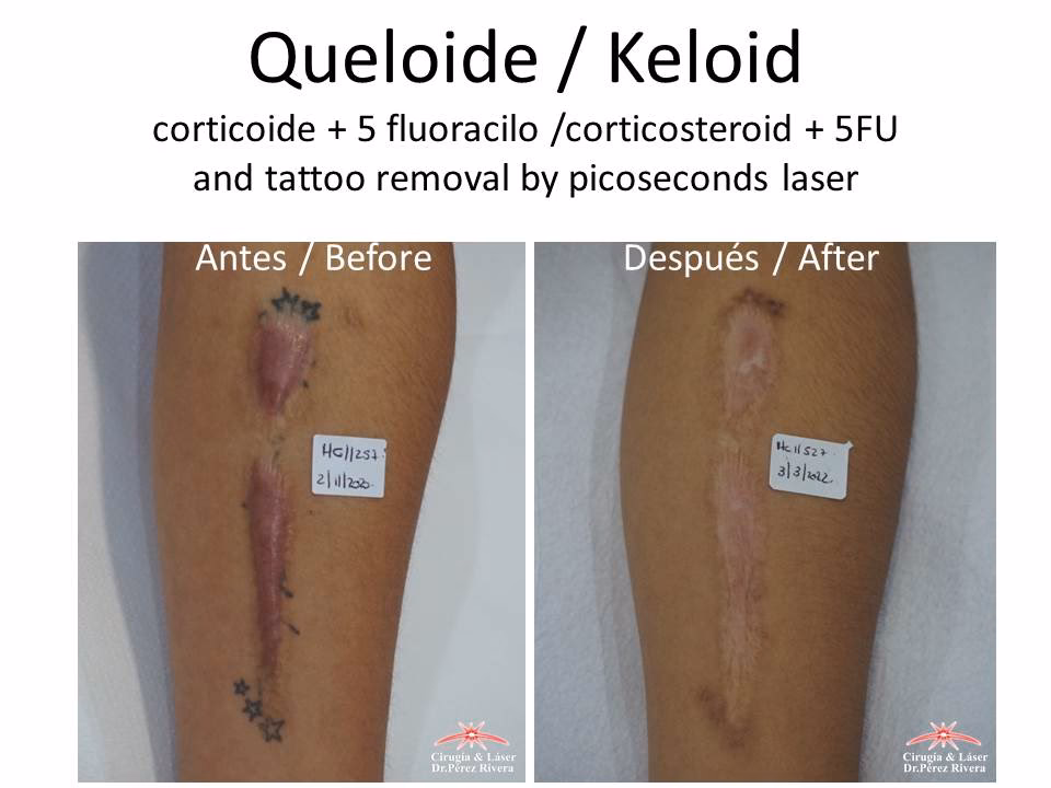 ¿Cómo eliminar una cicatriz queloide definitivamente?