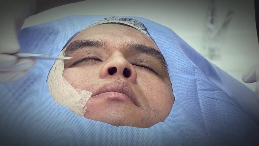 Electroestimulación en Parálisis Facial: ¿Funciona?