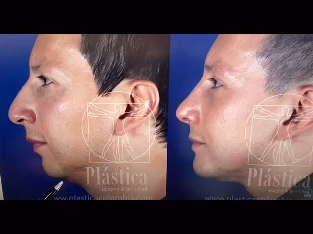 Cirugía de Mandíbula: Guía Completa de Precios y Procedimiento