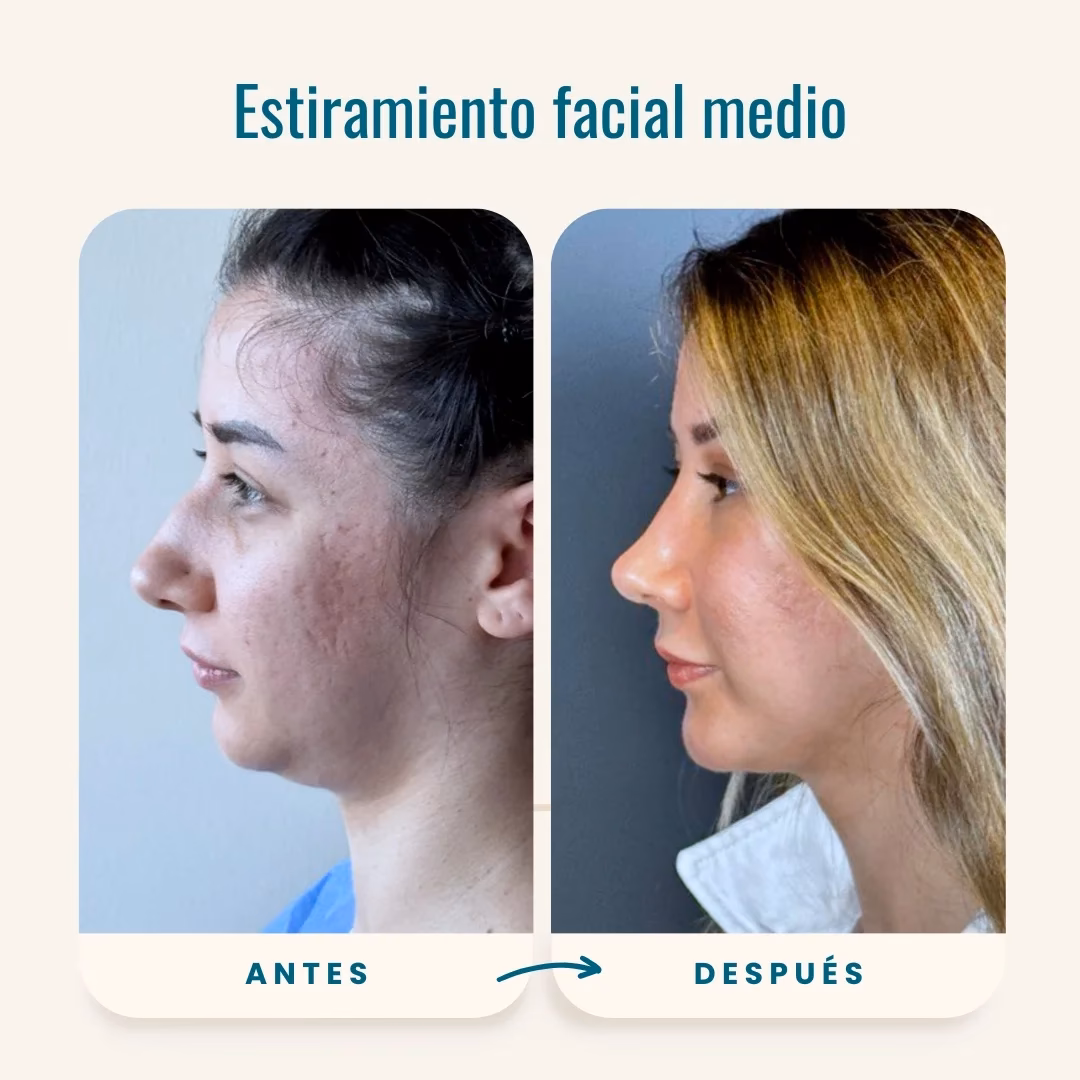 ¿Cómo se llama la cirugía para rejuvenecer el rostro?