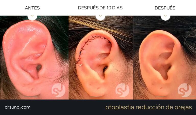 Otoplastia: La Solución para las Orejas Grandes