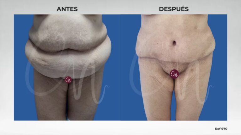 Cirugía Postbariátrica: El Toque Final a tu Figura