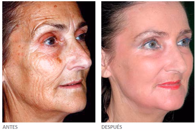 Aclaramiento de Piel: Precios y Tratamientos