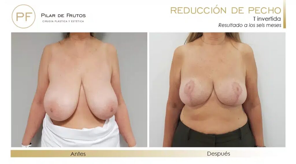 Reducción de Senos: Riesgos, Cuidados y Costos