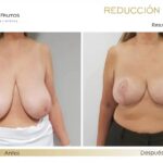 Reducción de Senos: Riesgos, Cuidados y Costos