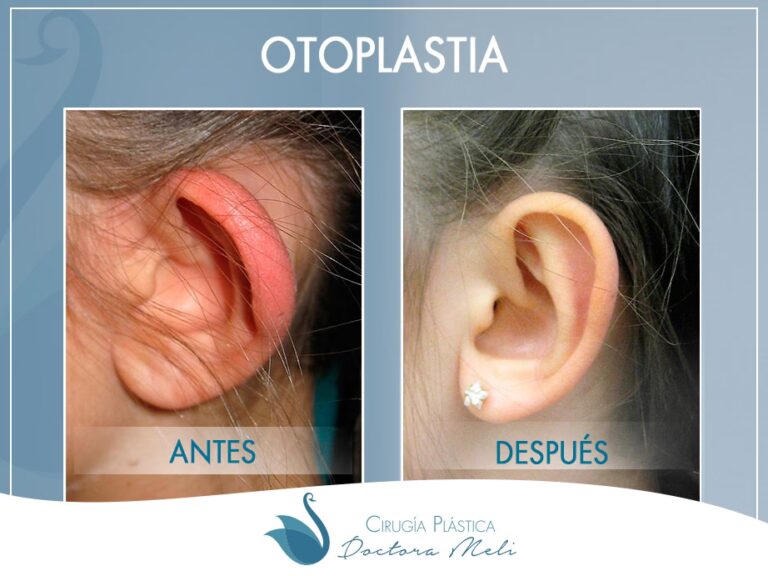 Otoplastia: Remodelando el Cartílago Auricular