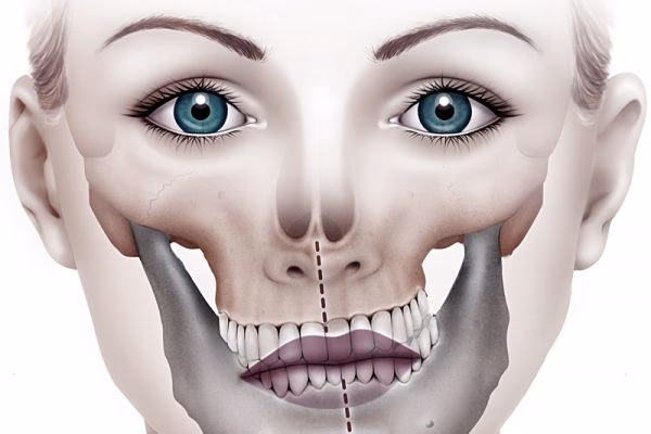 ¿Qué cirugía es para la asimetría facial?