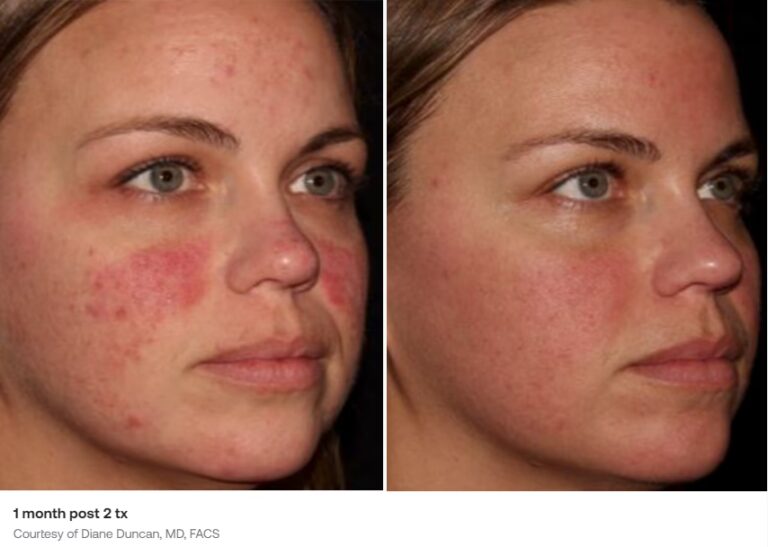 Eliminación de Pecas: Guía Láser Definitiva