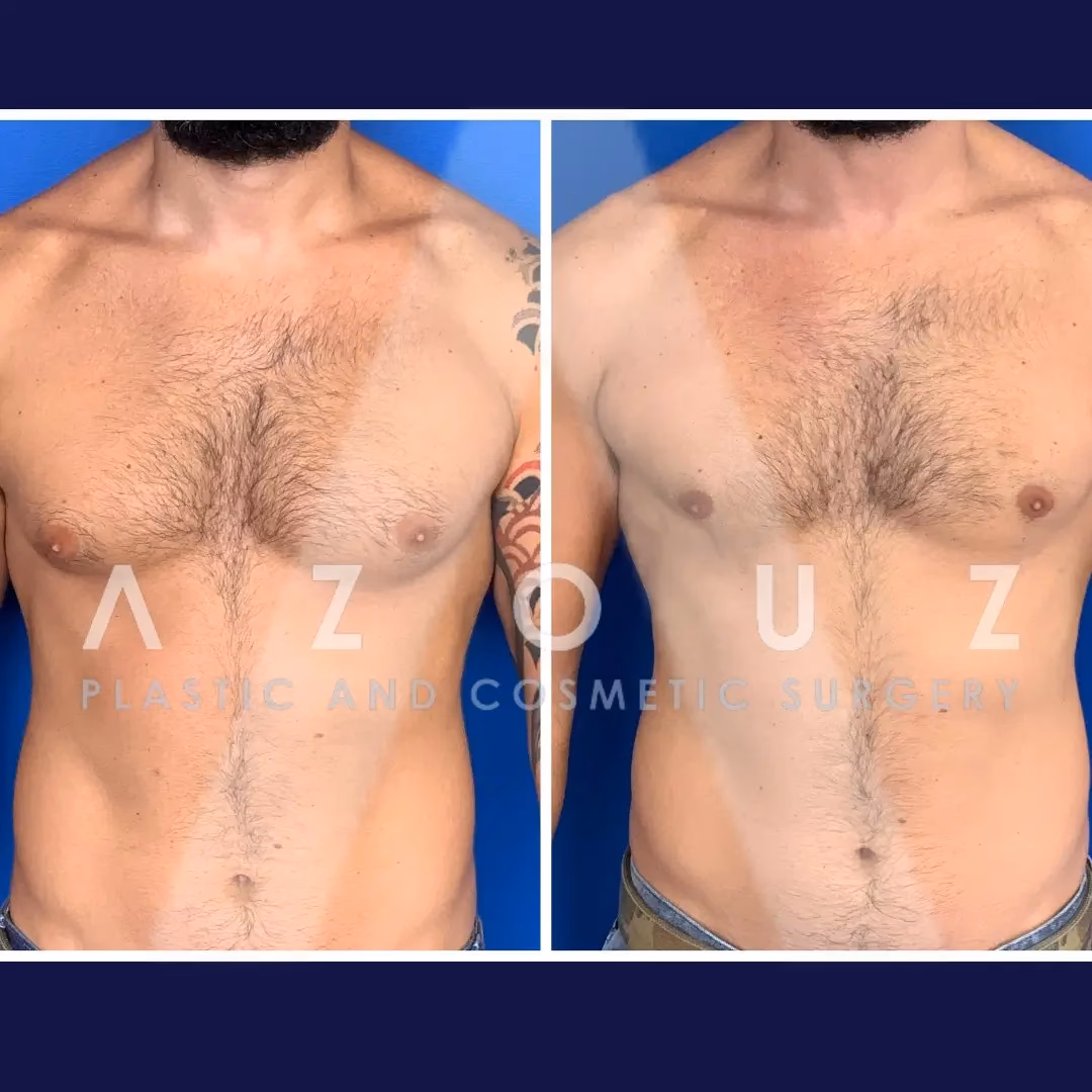 ¿Qué tan riesgosa es la cirugía de ginecomastia?