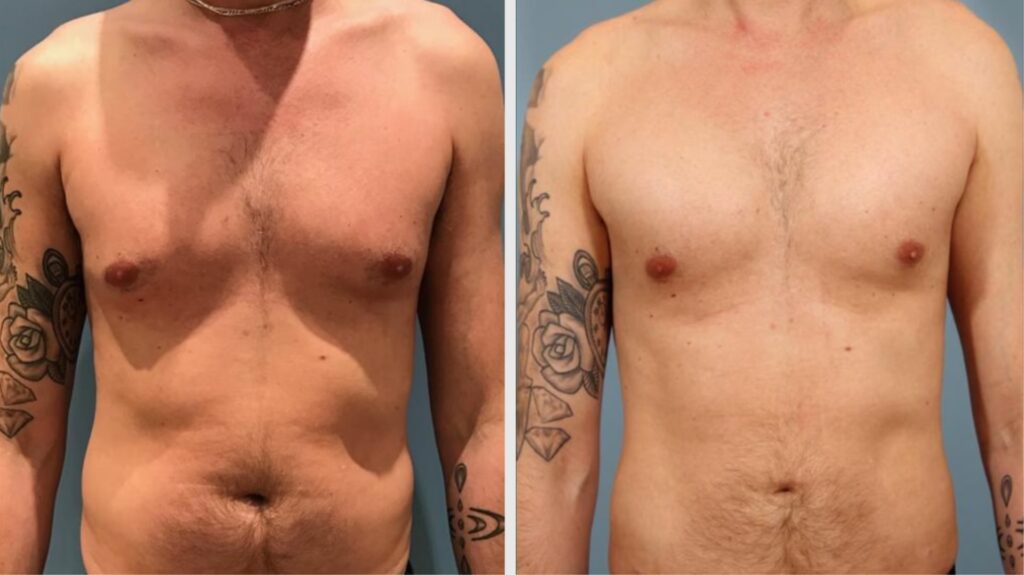 Cirugía Pectoral Masculina: Guía de Costos