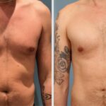 Precio de la Ginecomastia: Guía de Costos 2024