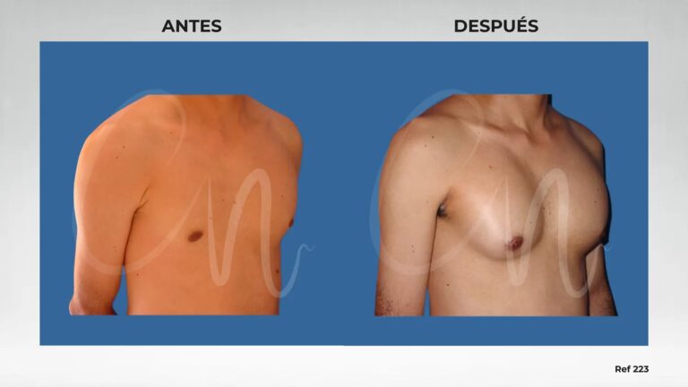Aumento de Pecho Natural: ¿Cuál es la Mejor Opción?