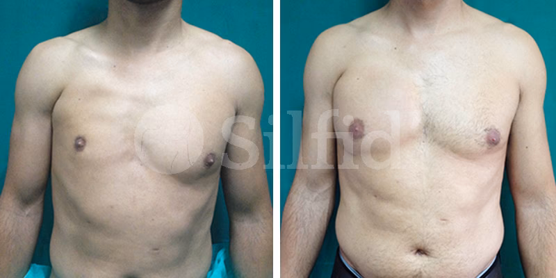 ¿Cuánto cuesta operarse los pectorales de un hombre?