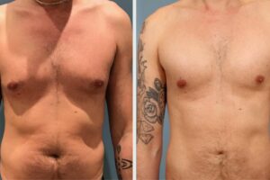 Precio de la Ginecomastia: Guía de Costos 2024