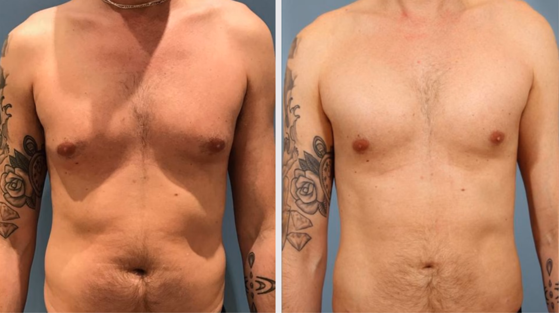 ¿Cuánto cuesta una operación de quitar el pecho?