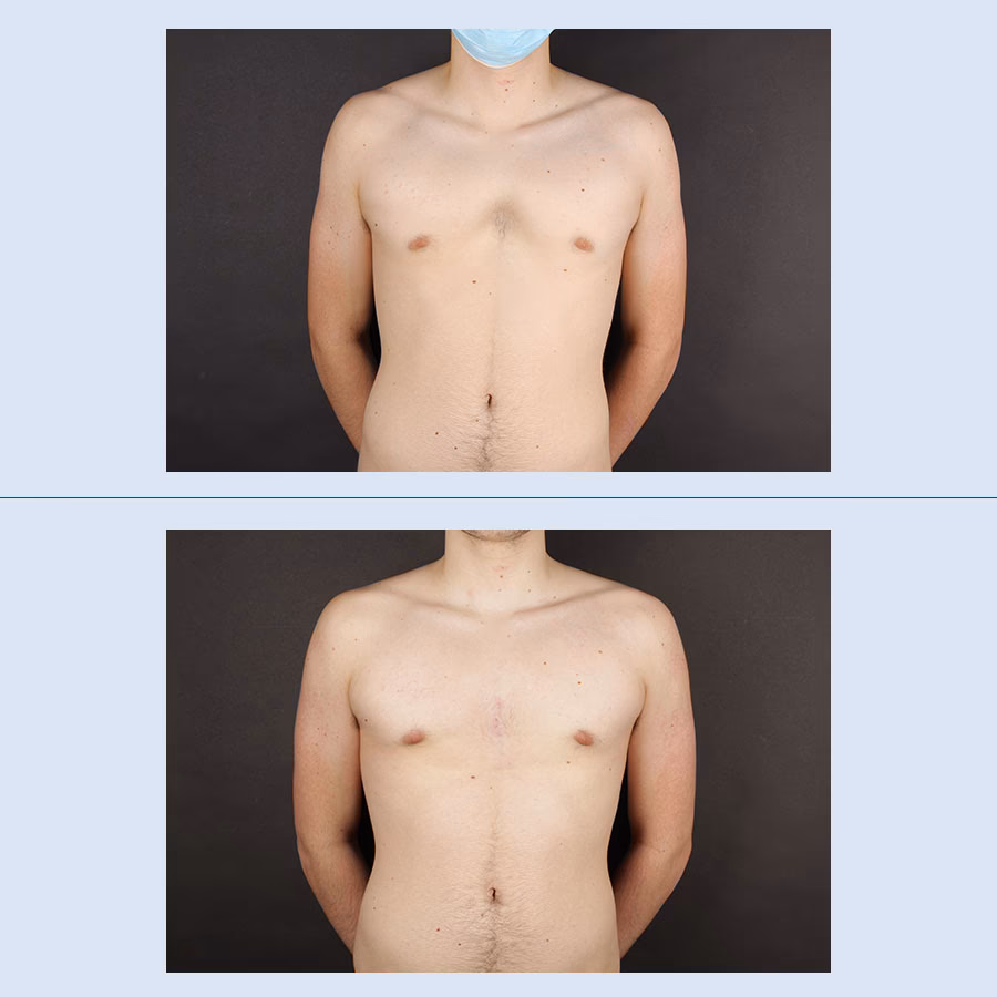 ¿Qué tan riesgosa es la operación de pectus excavatum?