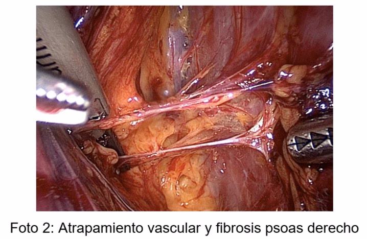 ¿Cuáles son las cirugías pélvicas?